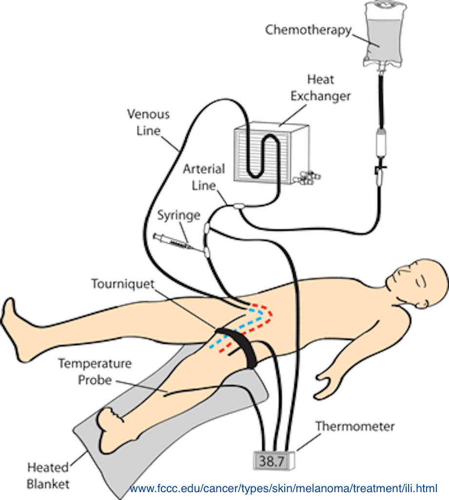 Isolated limb infusion technique