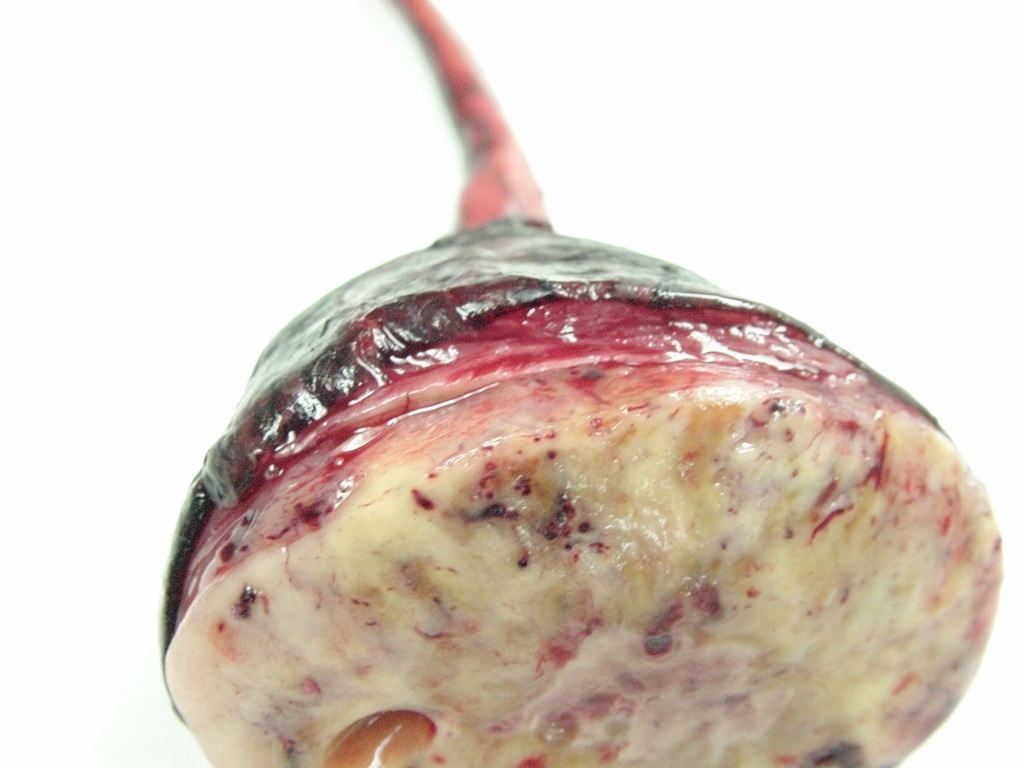 An example of a soft tissue sarcoma grossly distending a muscle but remaining within it