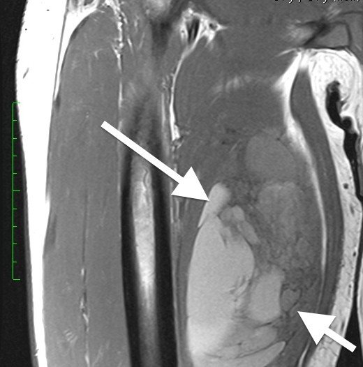 Undifferentiated sarcoma, medial thigh, brighter areas are due to hemorrhage within the tumor, often seen in high grade tumors