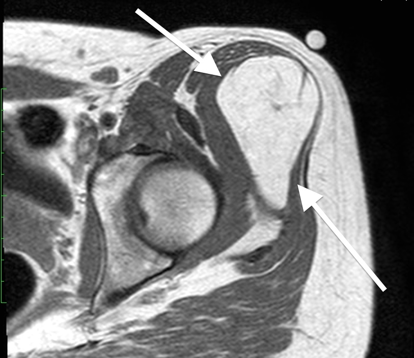 Lipoma overlying hip region, note similarity in appearance to nearby subcutaneous fat