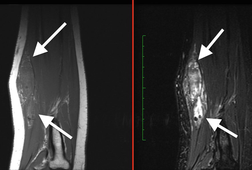Venous malformation in forearm, two different MRI sequences showing fat & fluid content