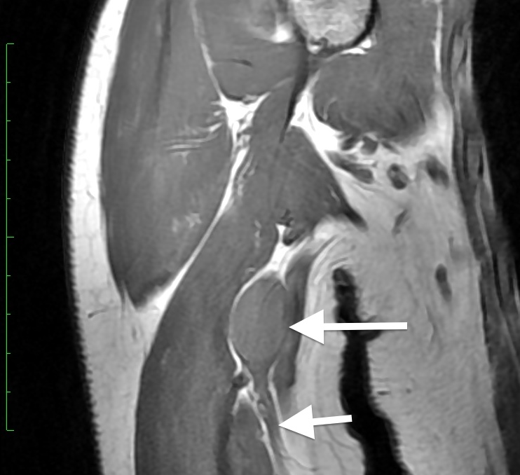 Schwanomma in arm nerve, note nerve (short arrow) exiting tumor (long arrow)
