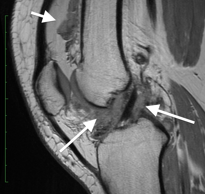 "Diffuse" PVNS in knee, notice tumor throughout knee joint as well as large amount of joint fluid (short arrow)