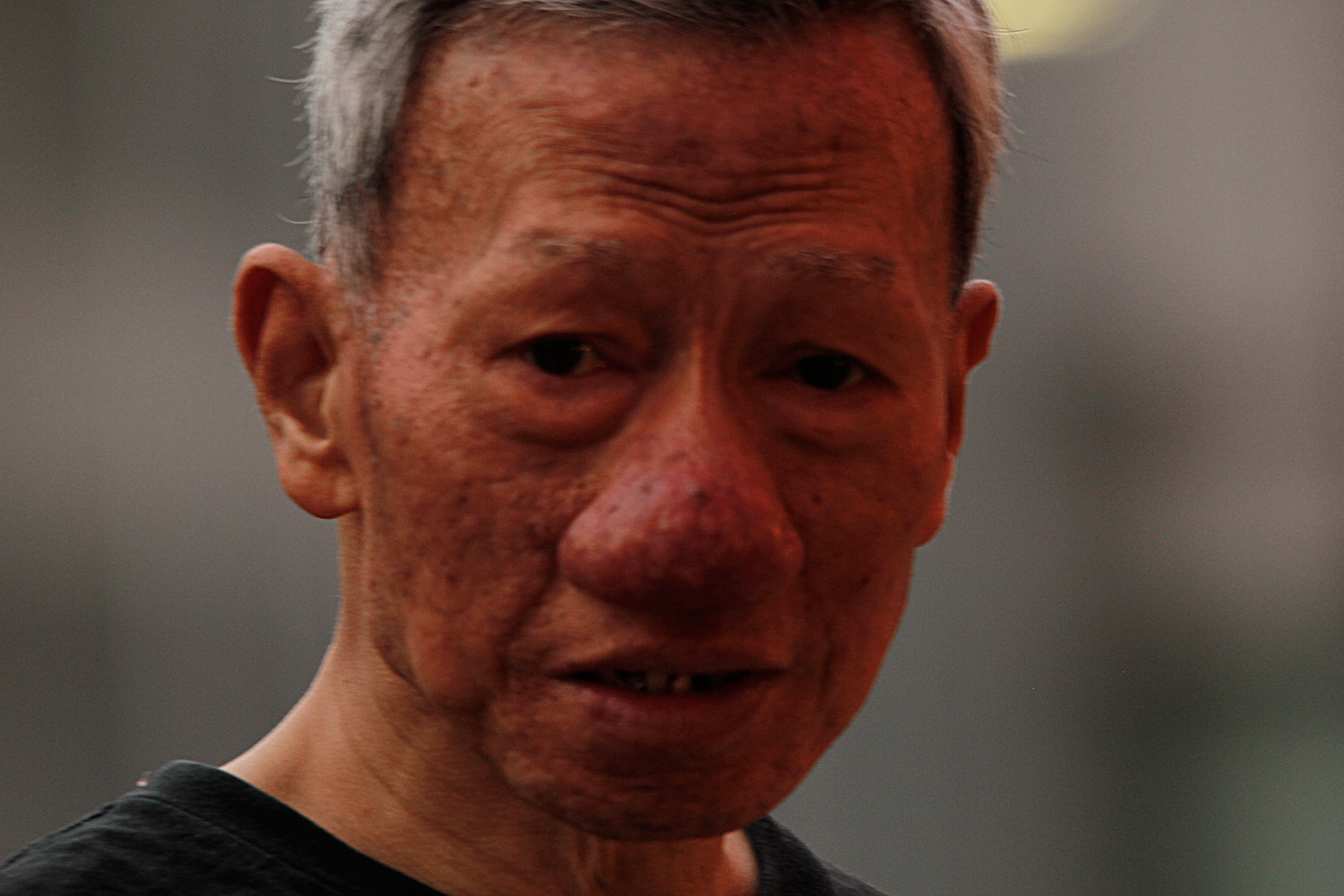 Rhinophyma