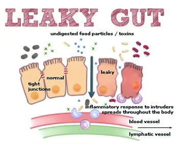 leaky-Gut.jpg