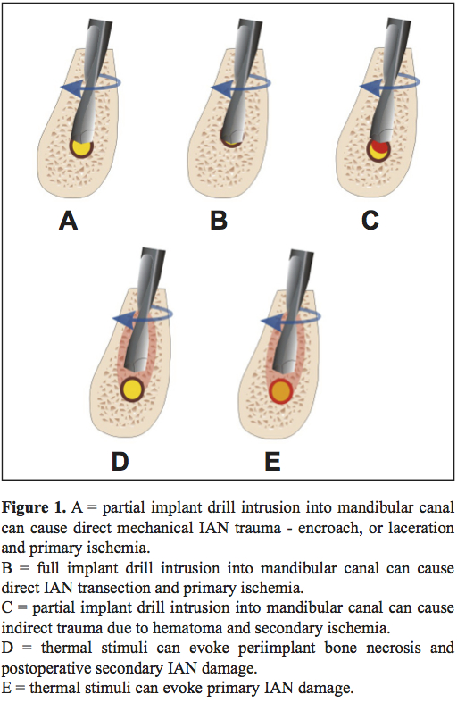 Injury of the inferior alveolar nerve during implant placement a
