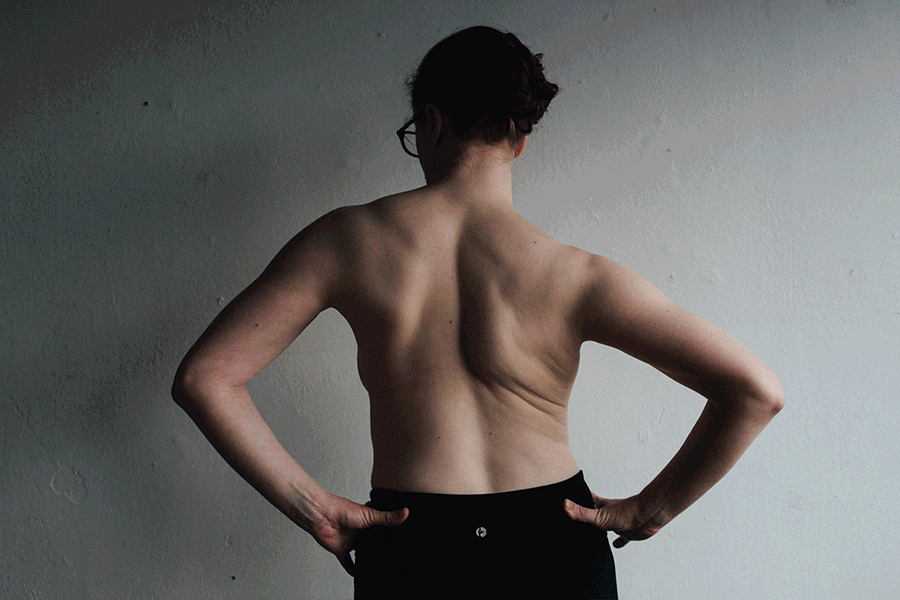 Jaclyn Todd has been living with Ehlers-Danlos Syndrome her whole life. It's a rare condition which effects the collagen in her body, allowing her tissue to be pulled beyond normal limits. The problems resulting from one's body being built out of a protein that behaves unreliably can be widespread and in a wide range of severity. 
