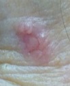 Basal cell carcinoma
