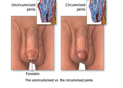 circumcised.jpg