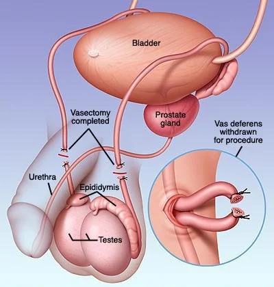vasectomy.jpg