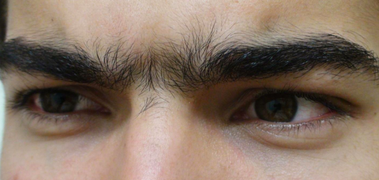 Remove Hair Between Eyebrows.jpg