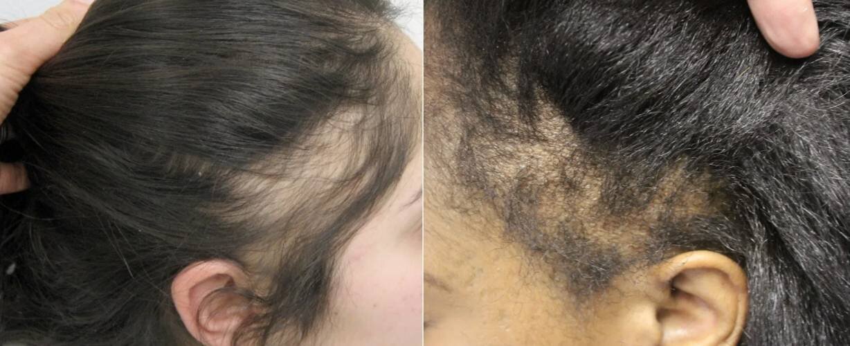 Traction Alopecia images.jpg