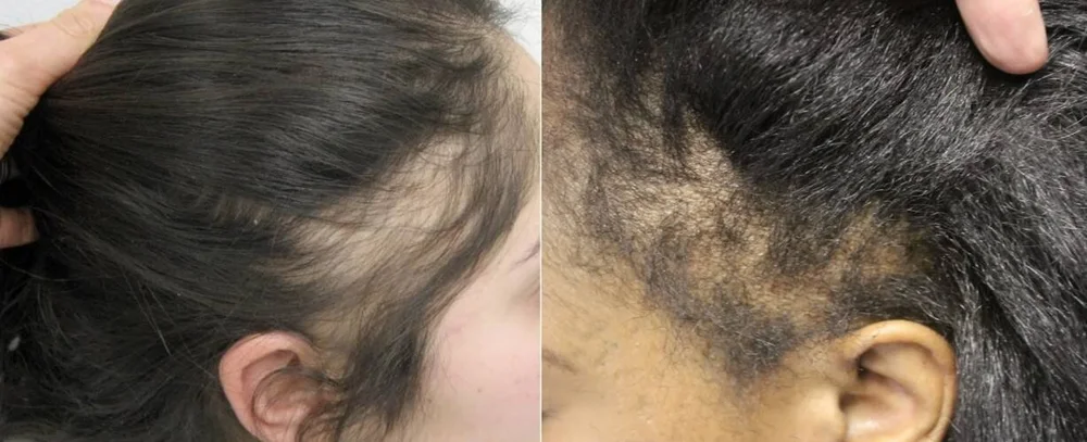 Traction Alopecia images.jpg