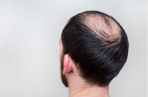 What Are Bald Patches and What Causes Them? — Posh Lifestyle & Beauty Blog