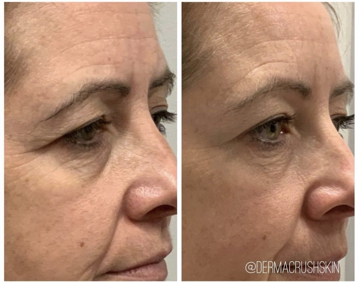 Botox brow lift before and after 2.jpeg