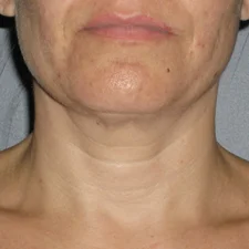 Ultherapy-0026-0086W_180Day_AFTER-1TX_Neck1_low-res.jpg