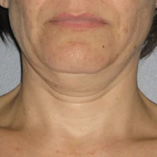 Ultherapy-0026-0086W_0Day_BEFORE_Neck1_low-res.jpg