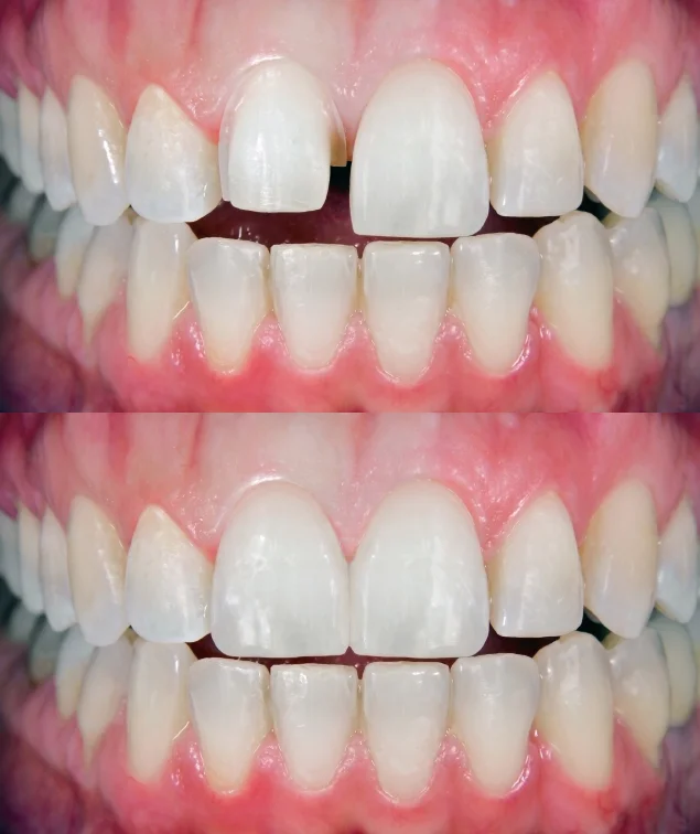 dr-mikula-veneer-before-after.jpg