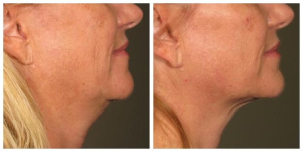 Lift Skin on Neck, Under the Chin and Above the Brow with Ultherapy
