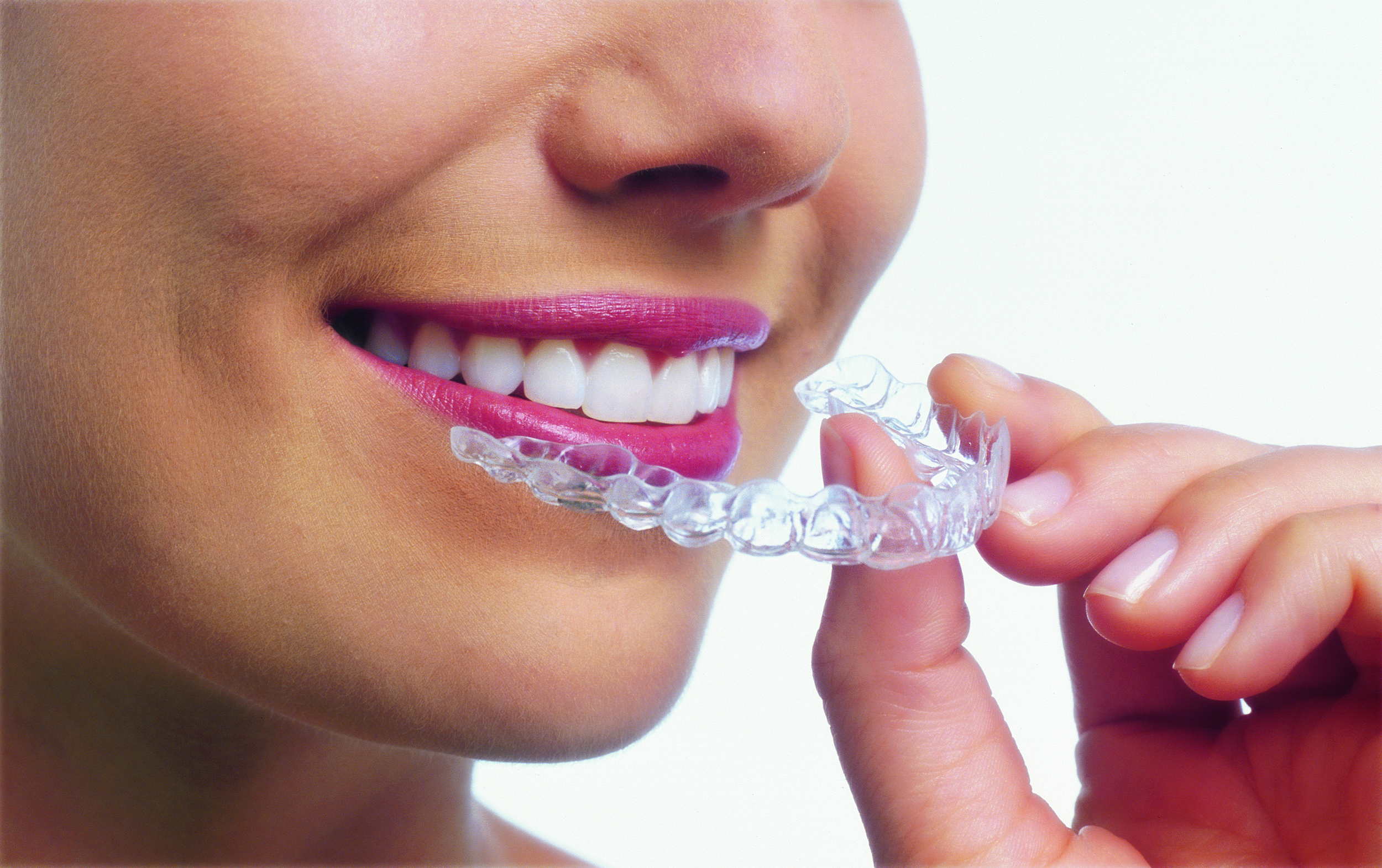 Invisalign aligner trays are made of smooth, comfortable and virtually invisible plastic that you wear over your teeth.