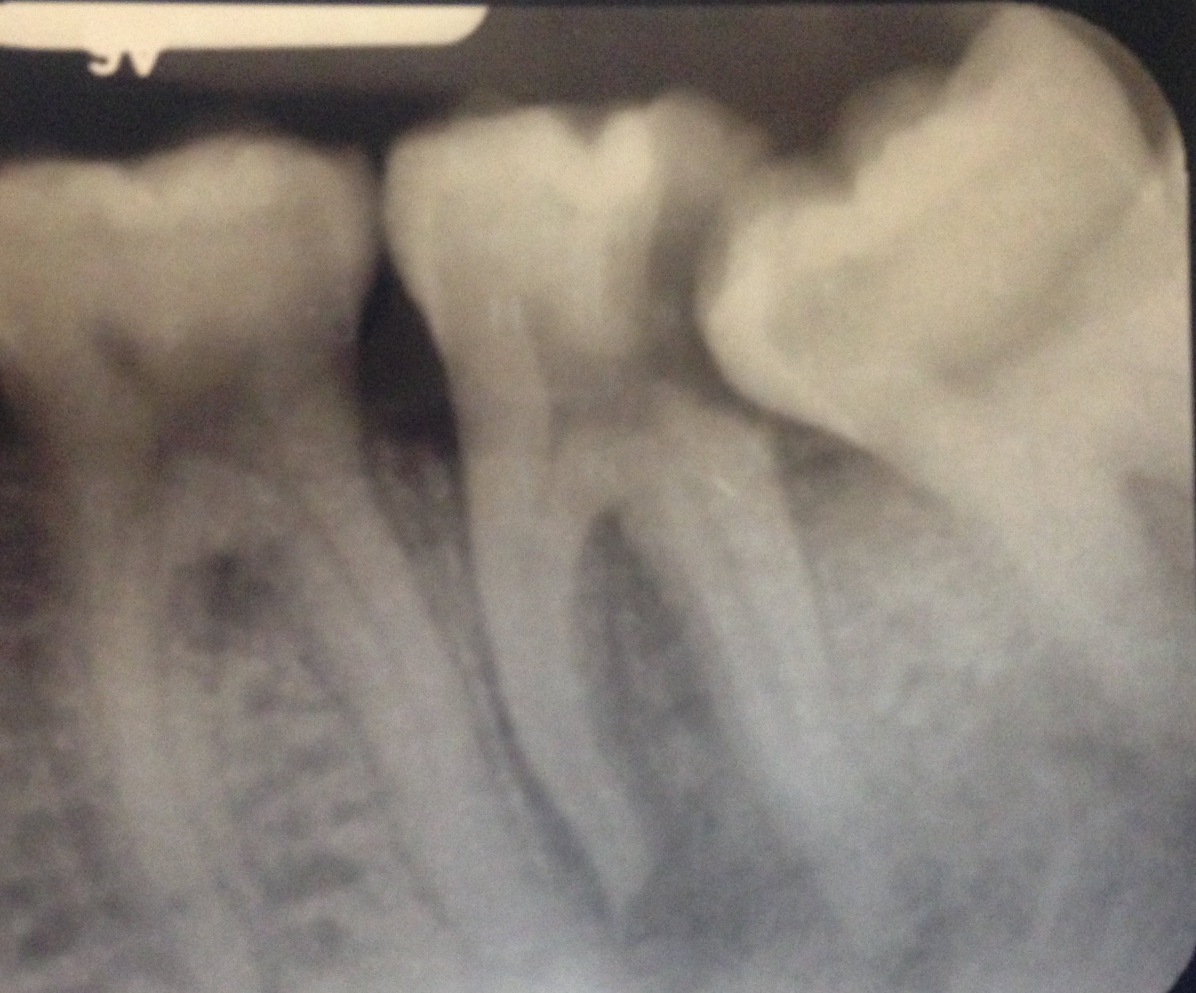 The potential for an impacted wisdom tooth pushing against and damaging a molar is a common concern.