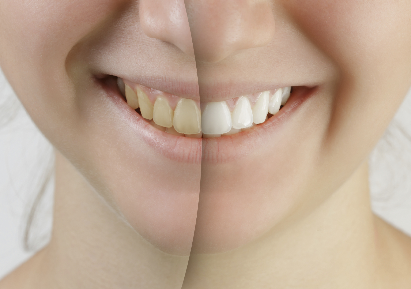 Did You Know There is an Ideal Shade of White for Your Teeth?