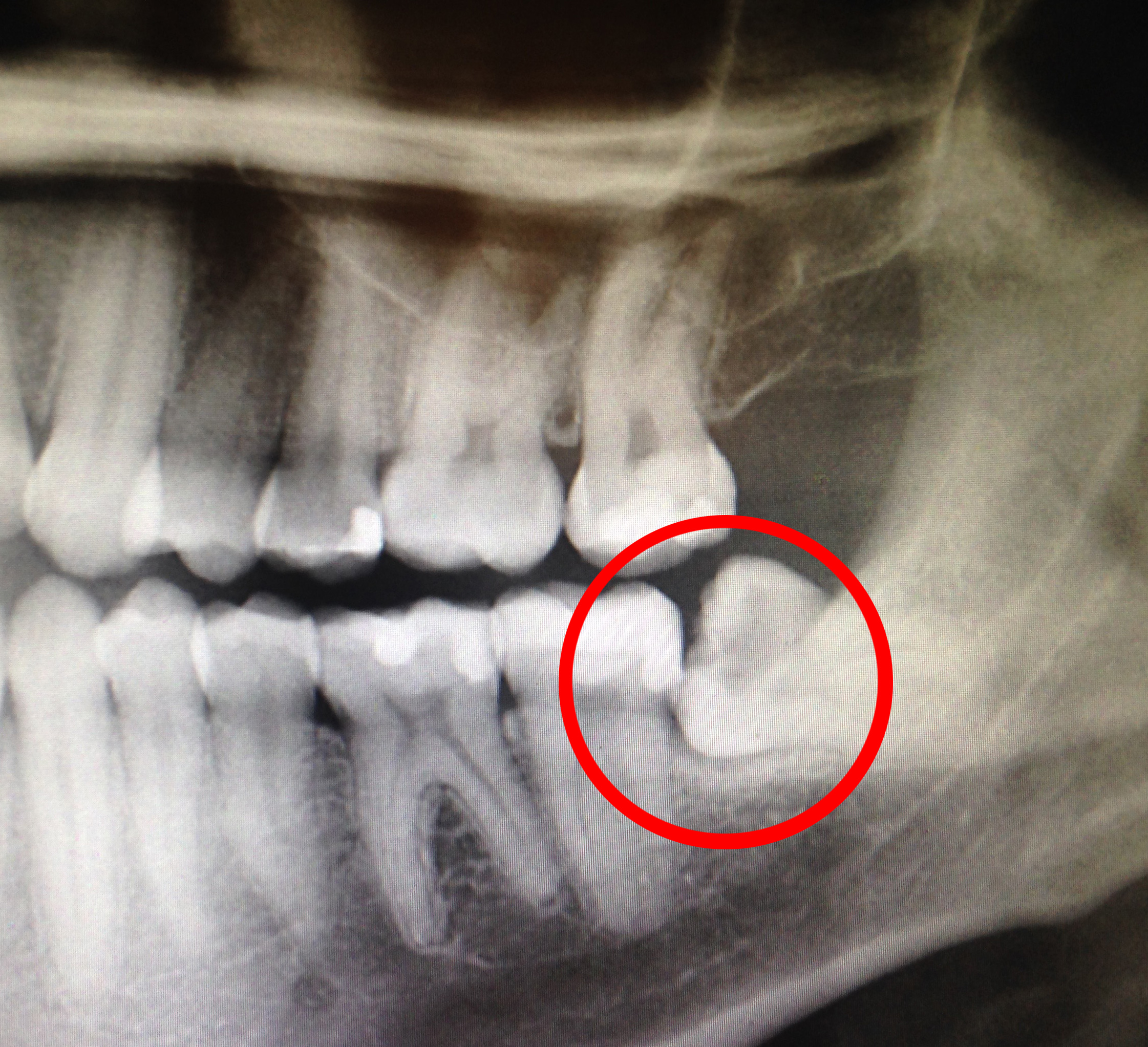 A wisdom tooth left unaddressed has impacted into the jaw and causing problems in the surrounding teeth.