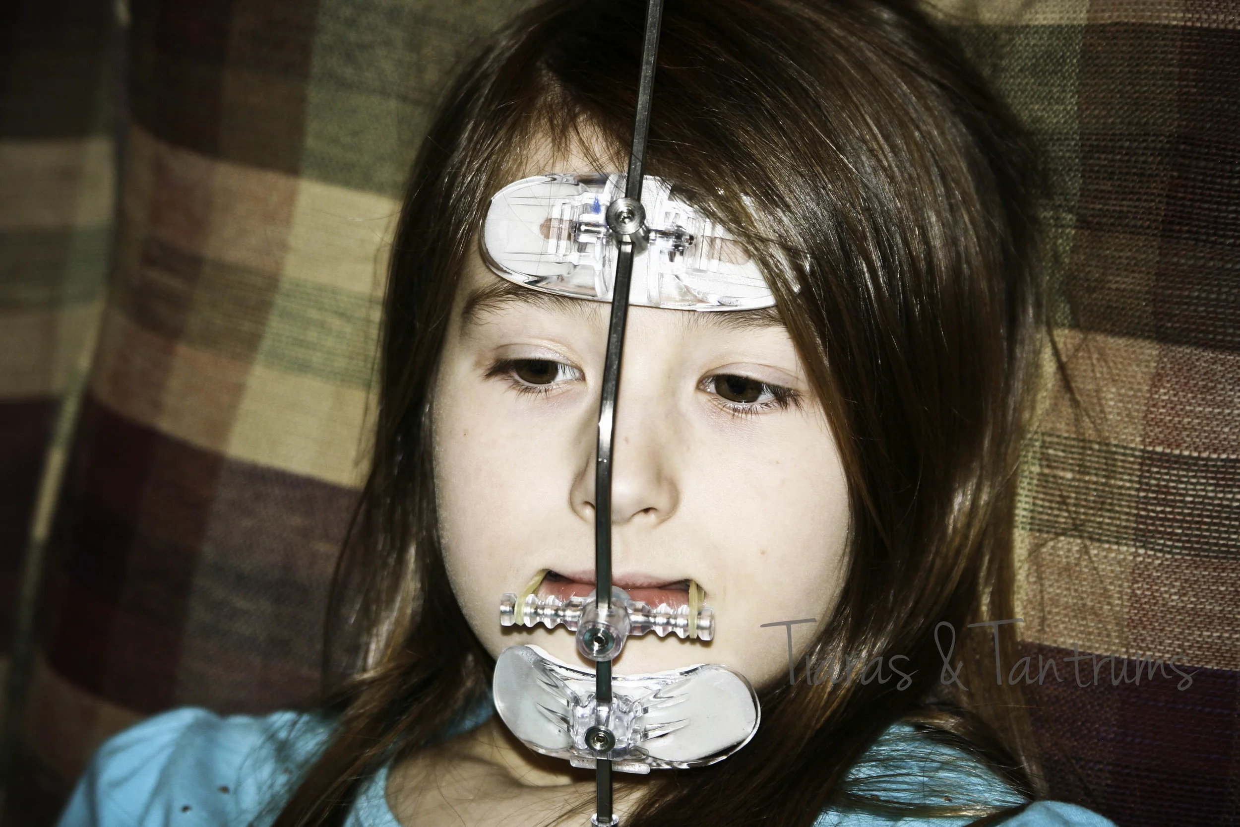 Rapid Palatal Expander What? — Tiaras & Tantrums