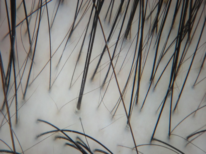 Miniaturized (or "thinning") hairs in androgenetic alopecia