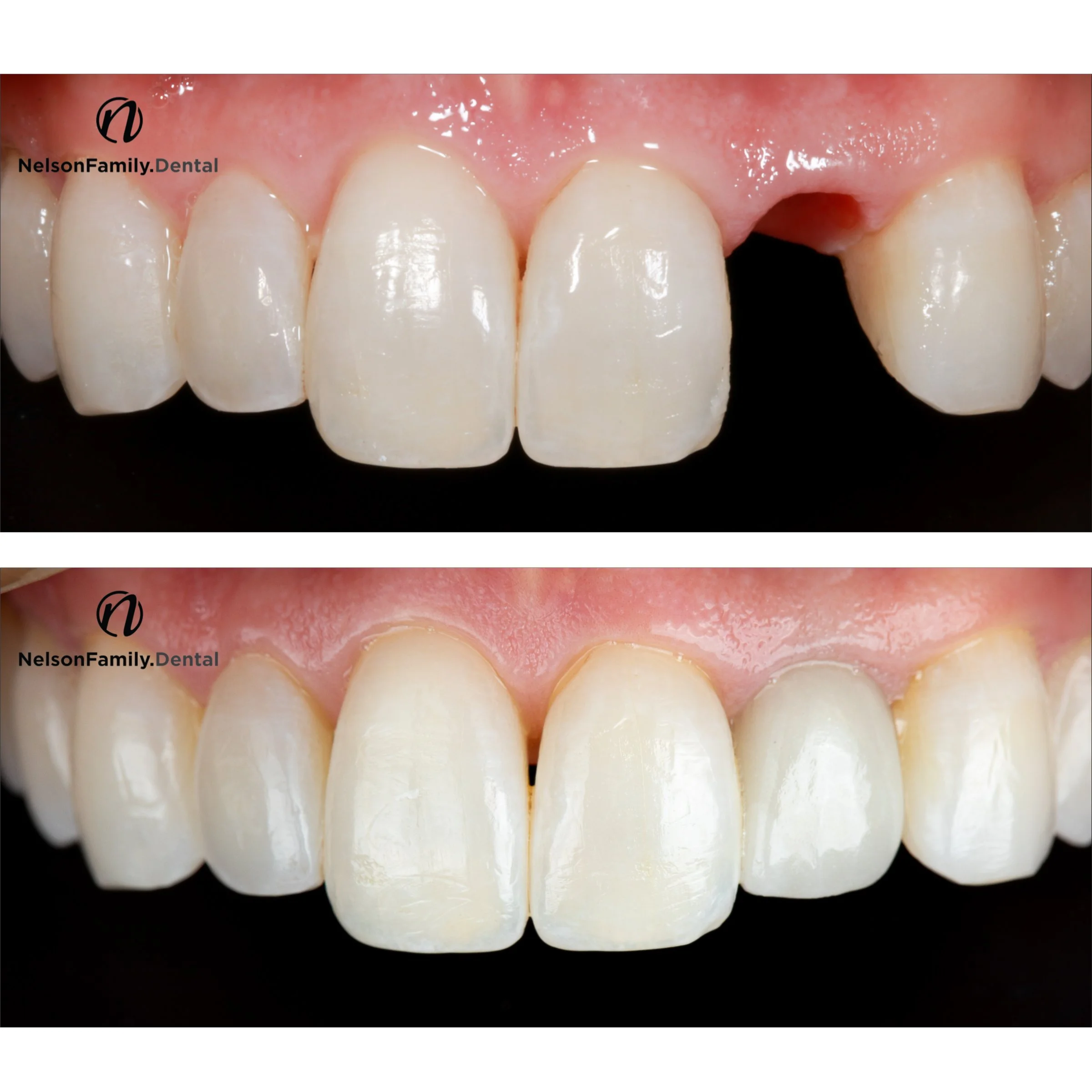 #10 Implant Kendra - Before and After.jpg