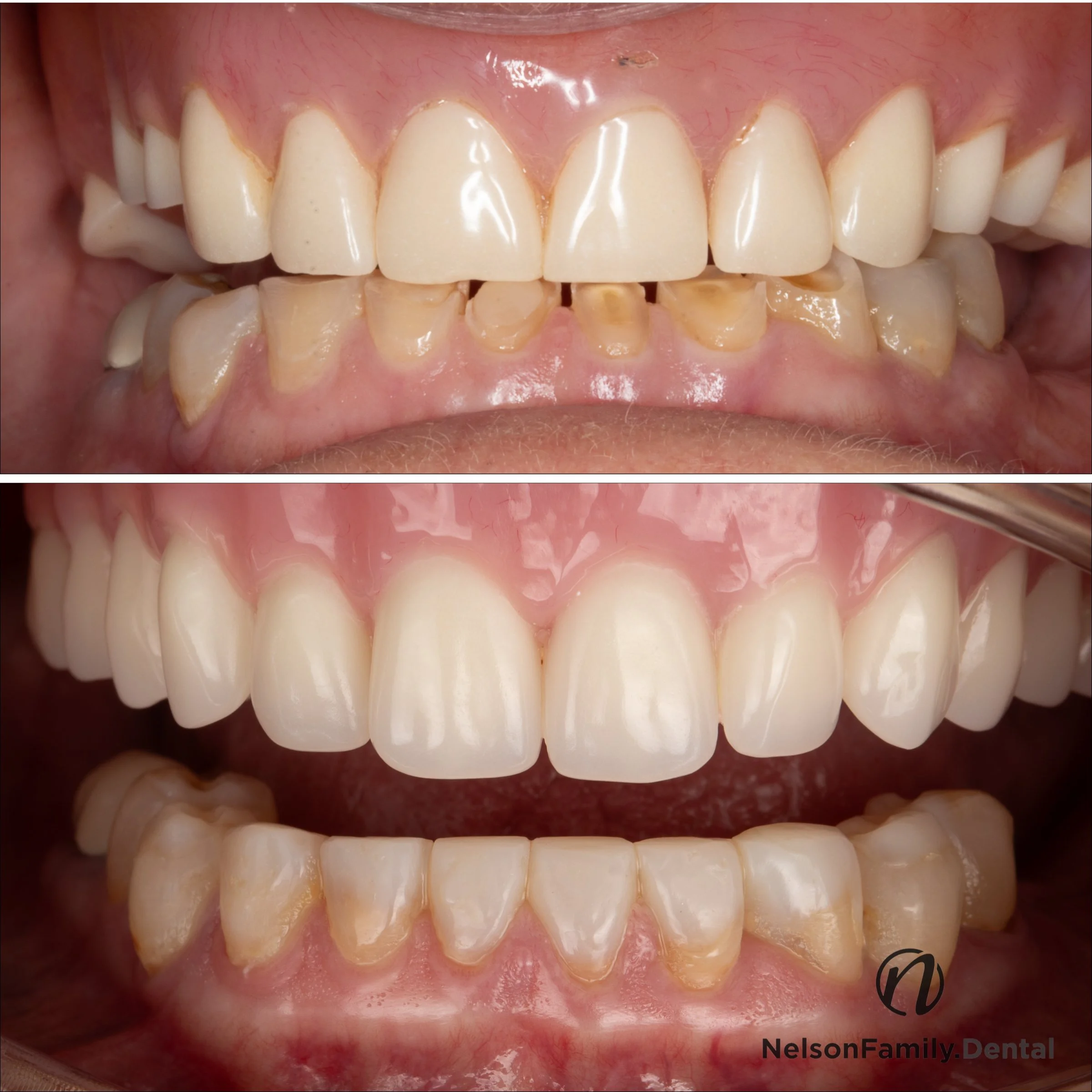 Full Upper Denture, Lower Composite Crowns 2.jpg