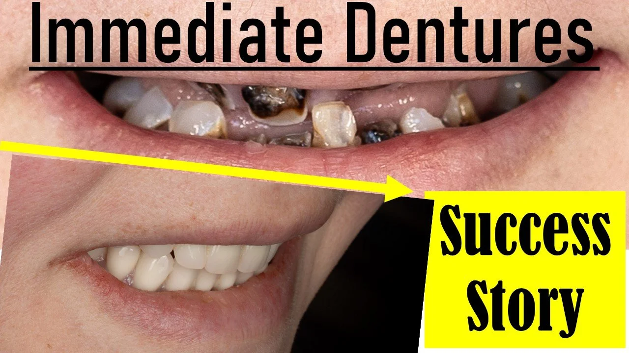 Immediate Dentures Success