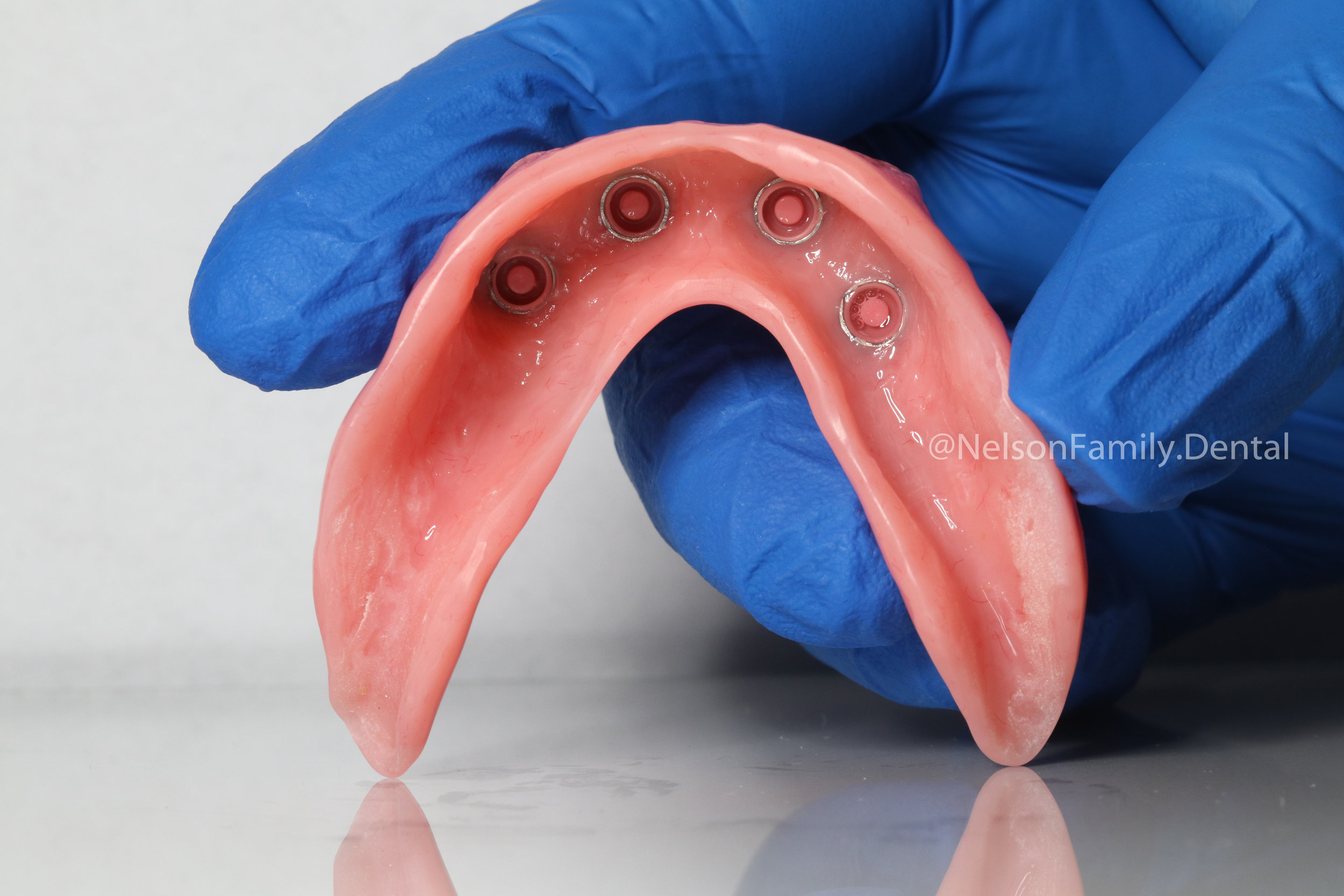 Porcelain-Denture-Implants-5785.jpg