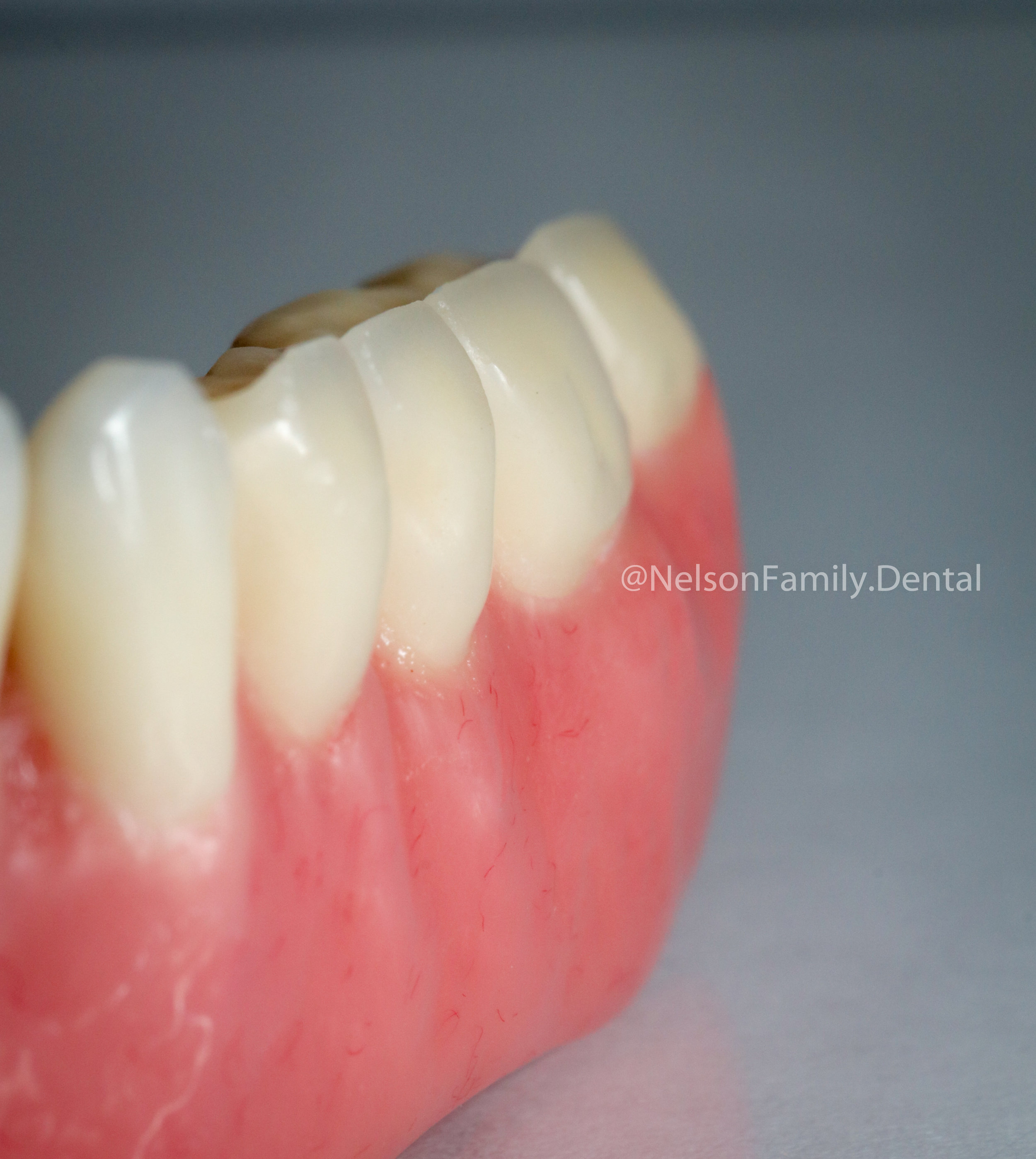 Porcelain-Denture-Implants-5782.jpg