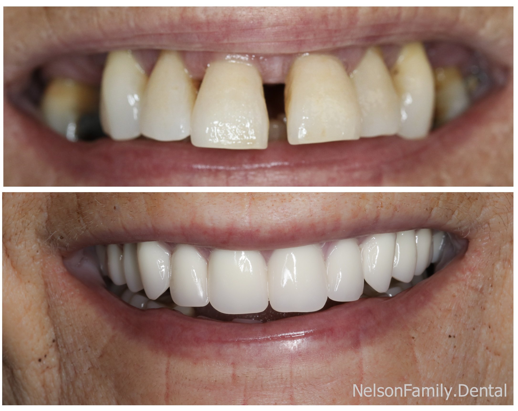 Denture%20Before%20-%20After%20B.%20Ev..jpg