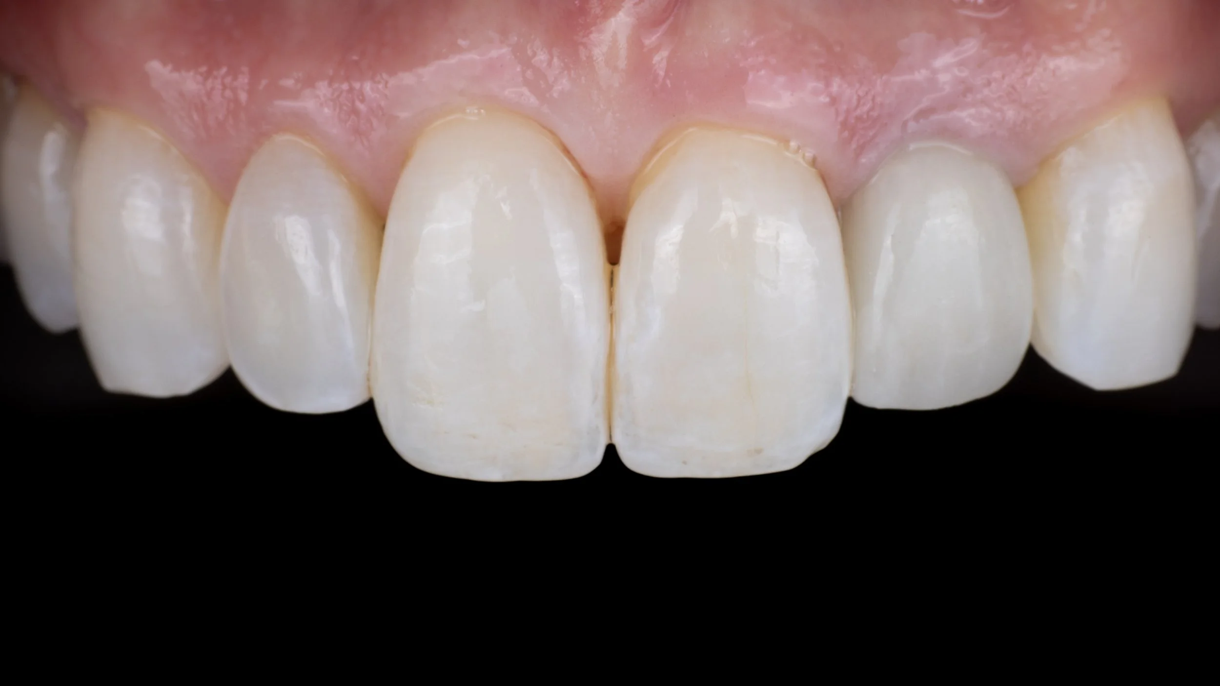 Front Tooth Dental Implant - Five Years Later