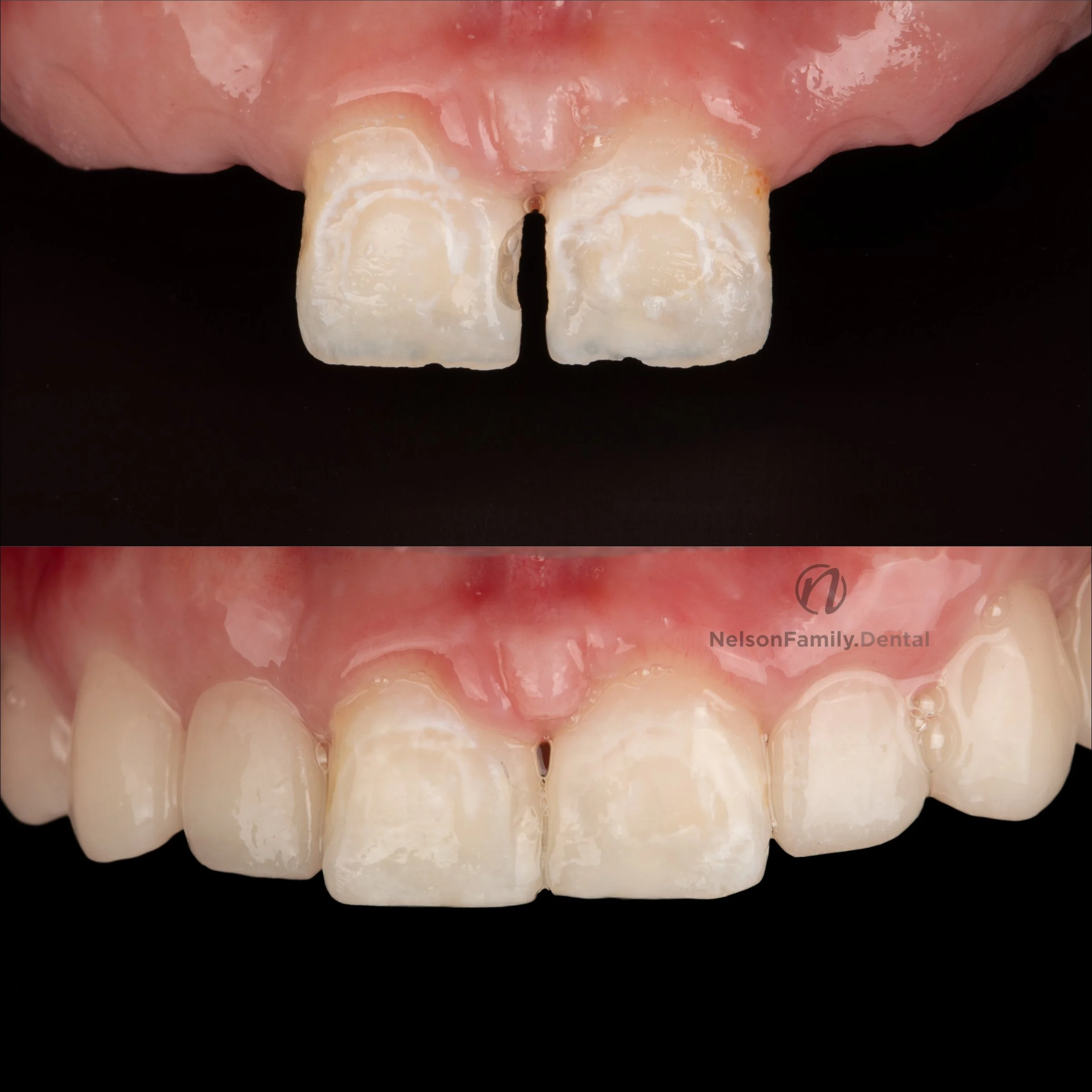Stayplate and Diastema Closure.jpg