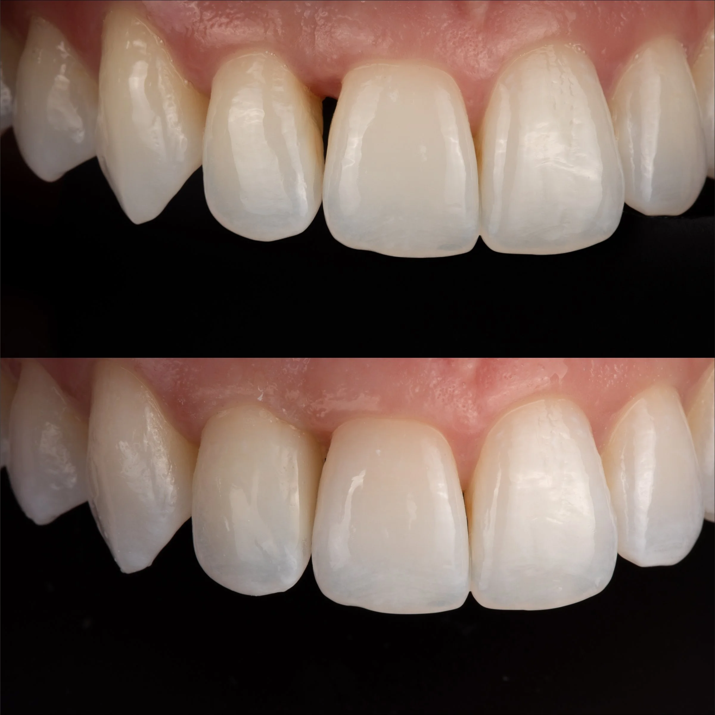 Bioclear Matrix #7 - Omni and A1 Estelite.jpg