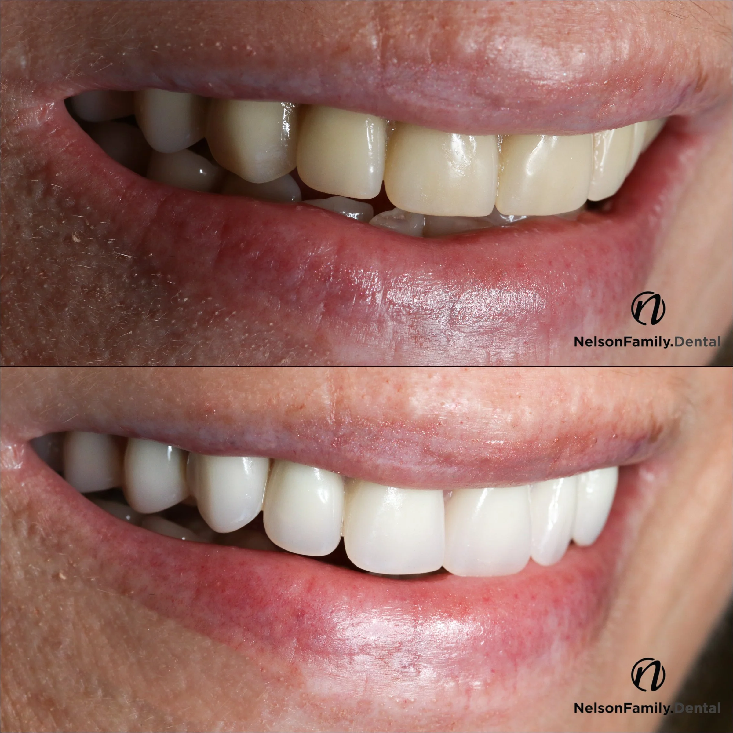 Denture before and after nice.jpg