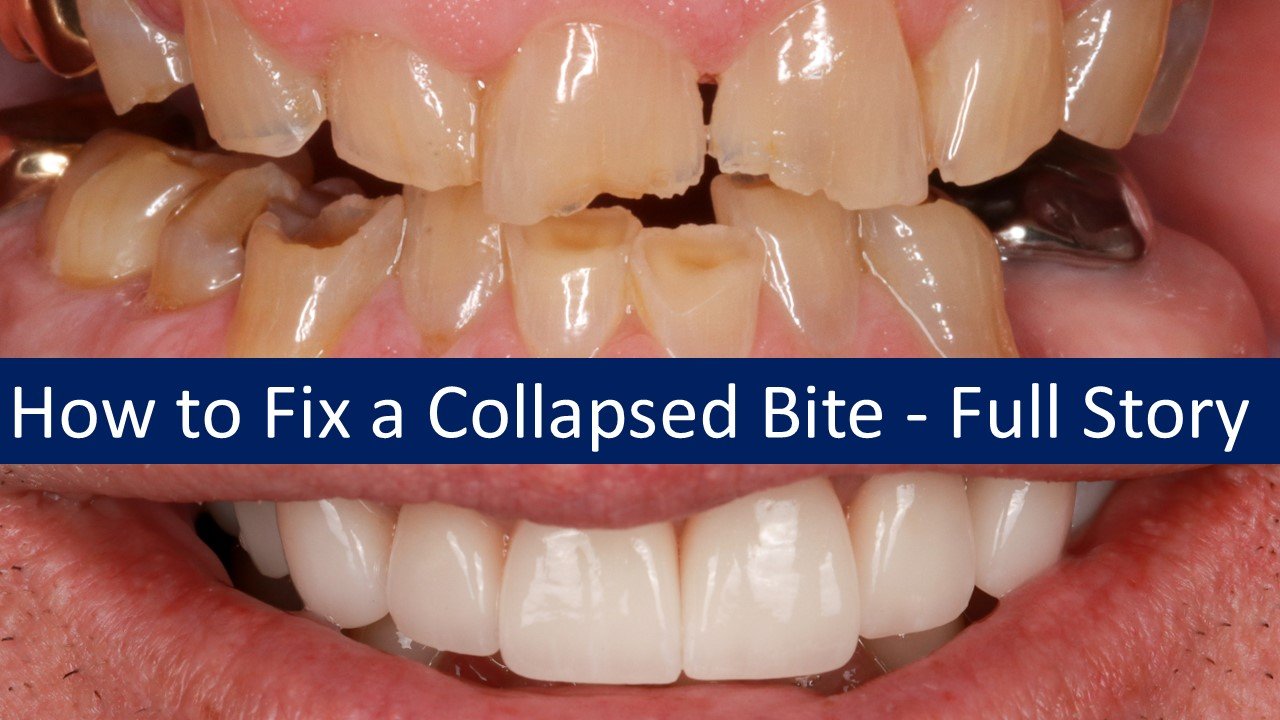 How to Fix a Collapsed Bite.jpg