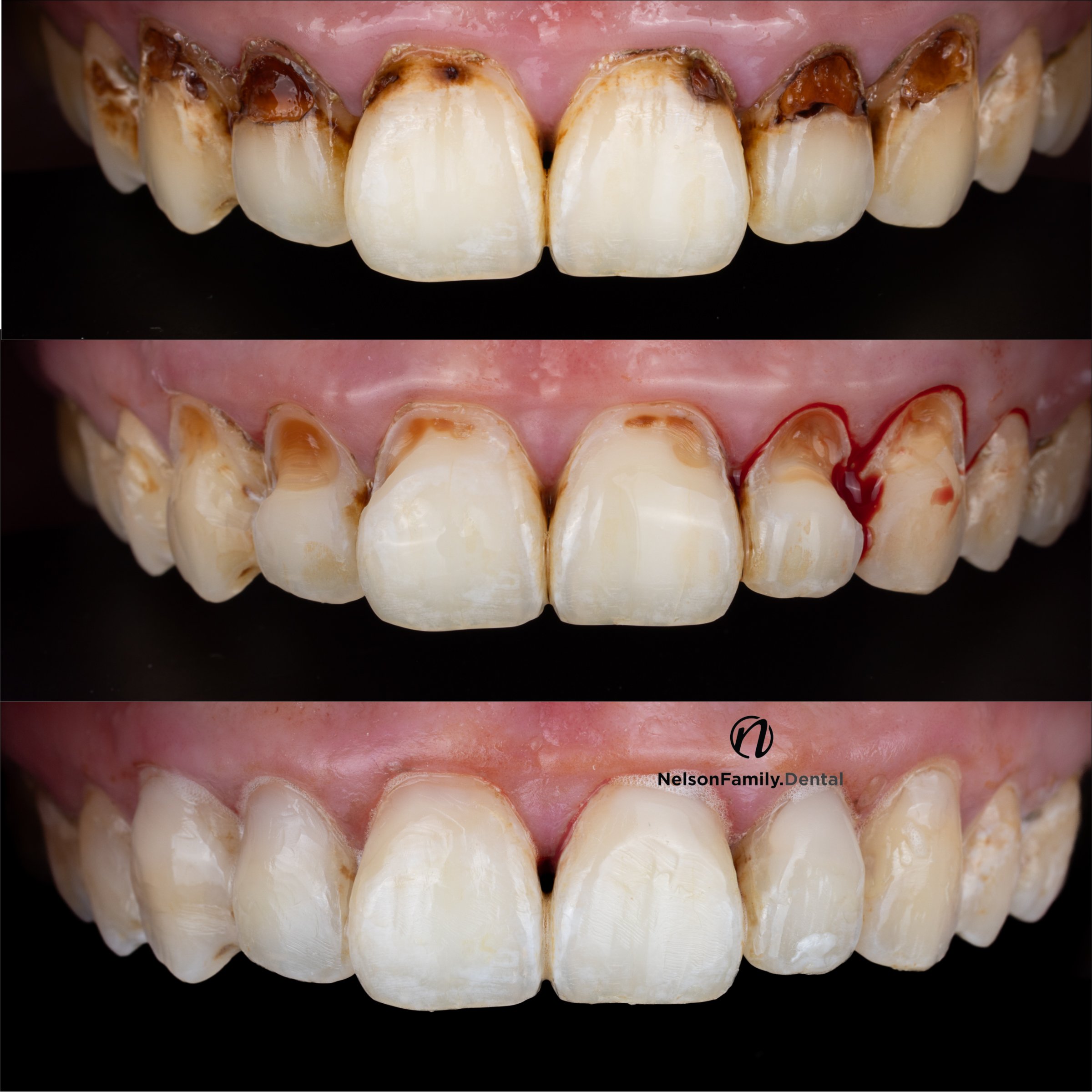 Cavities Before and After.jpg