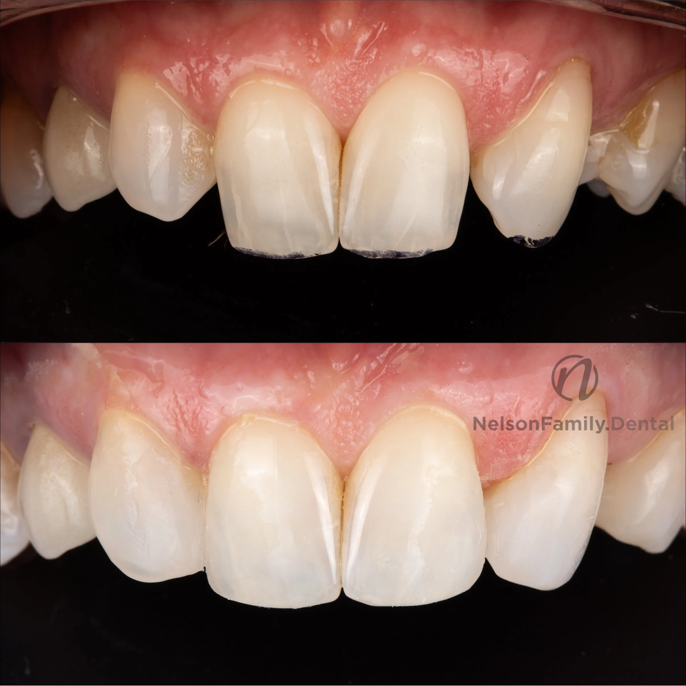 Composite Veneers chairside, direct, omniflow.jpg