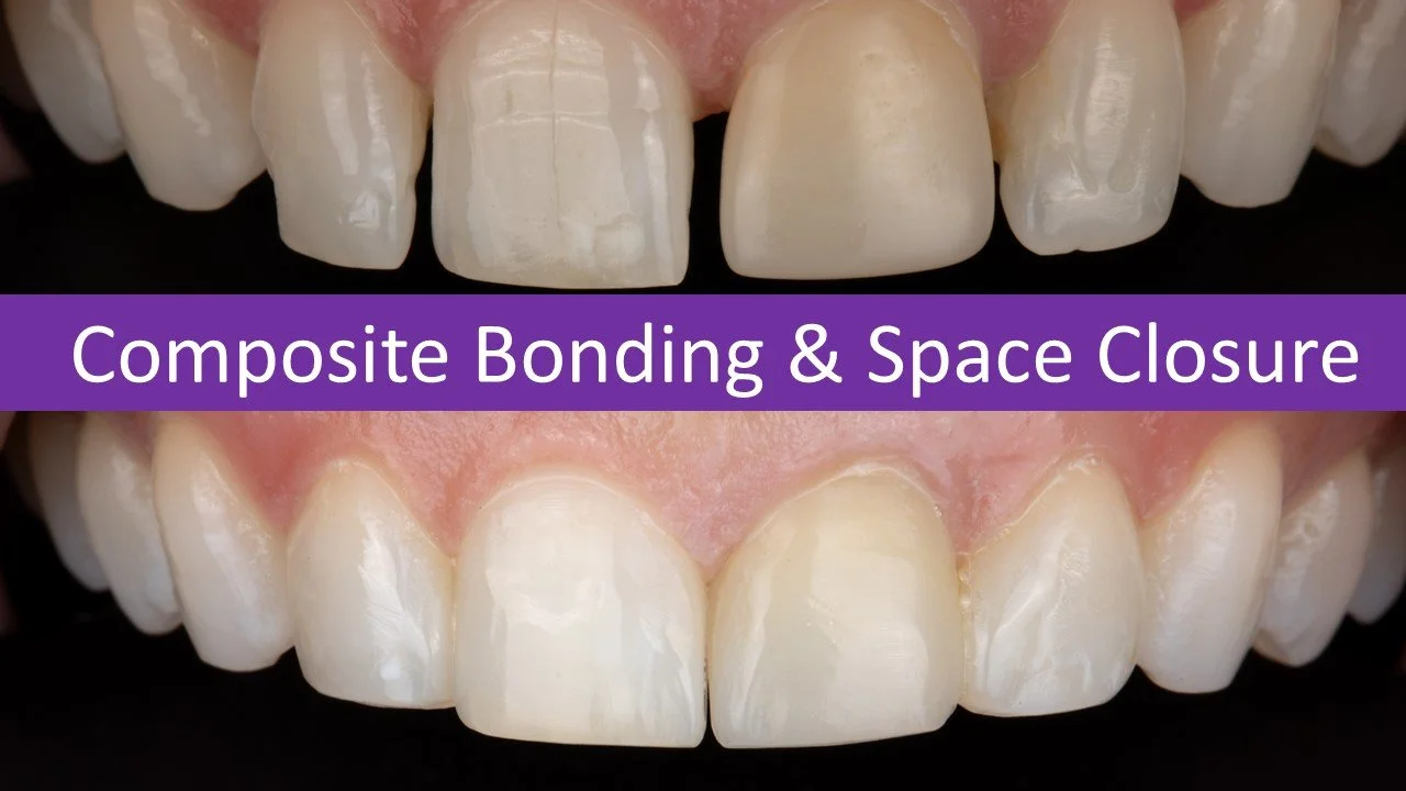 Composite Bonding and Diastema Closure.jpg