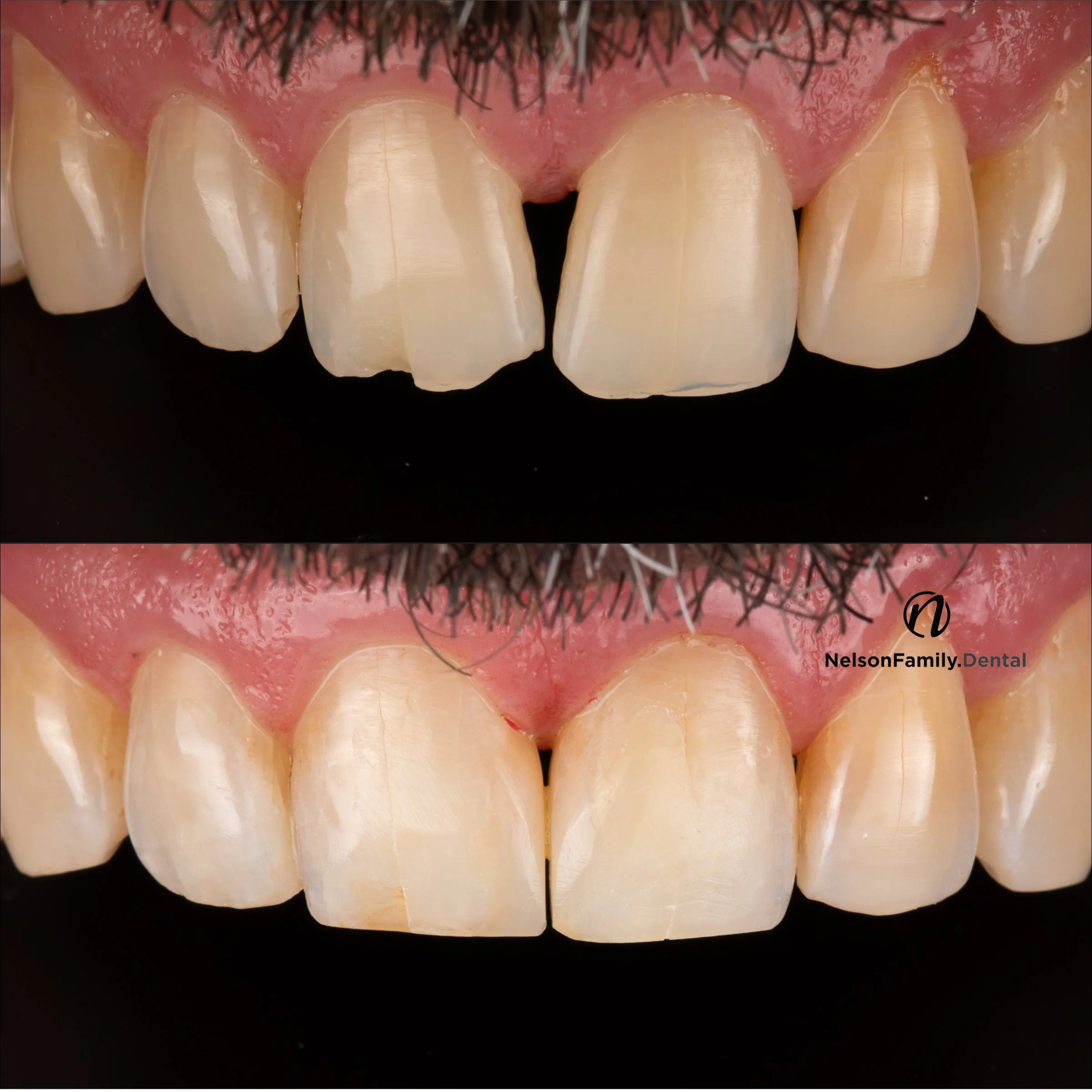 Black Triangle Reduction Bioclear Same Day No Anesthetic.jpg