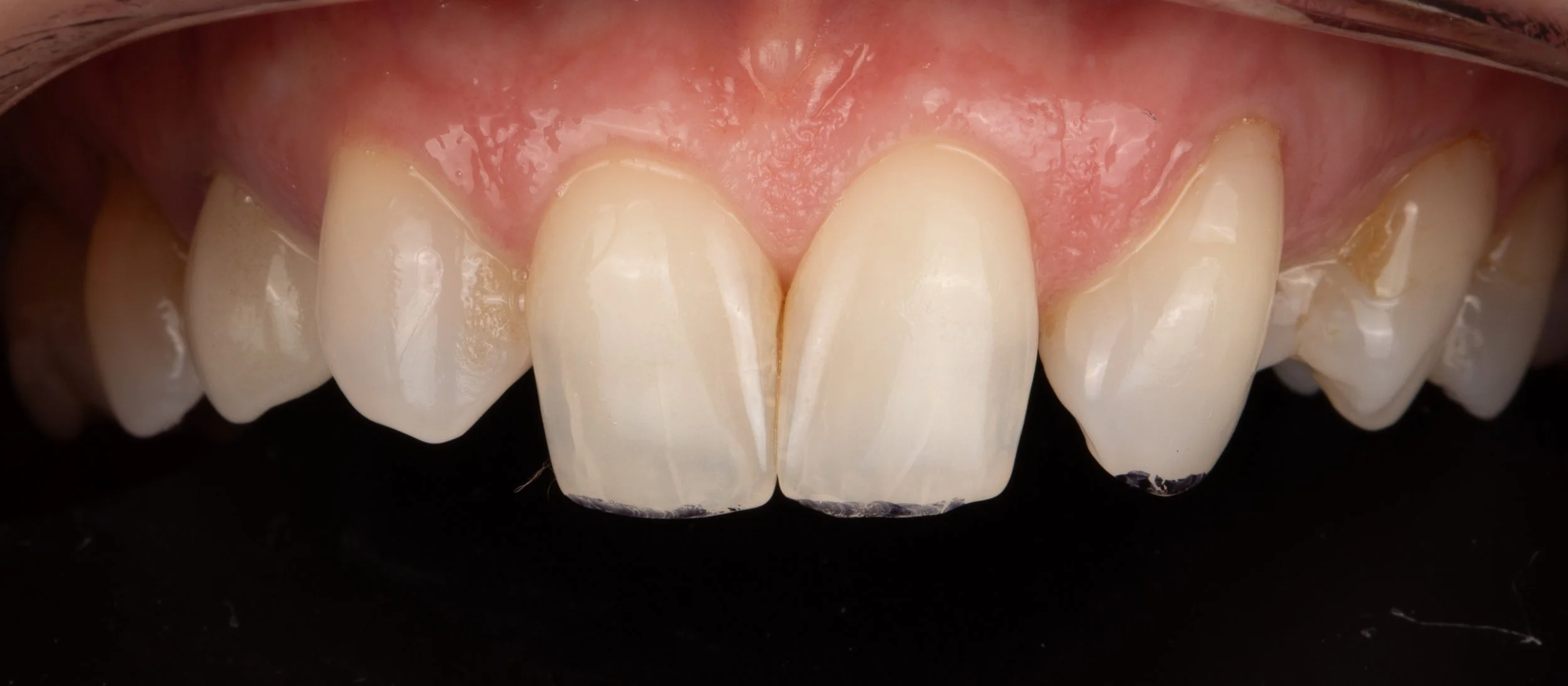 Before: The original front-tooth arrangement, with canine teeth in the lateral incisor positions.