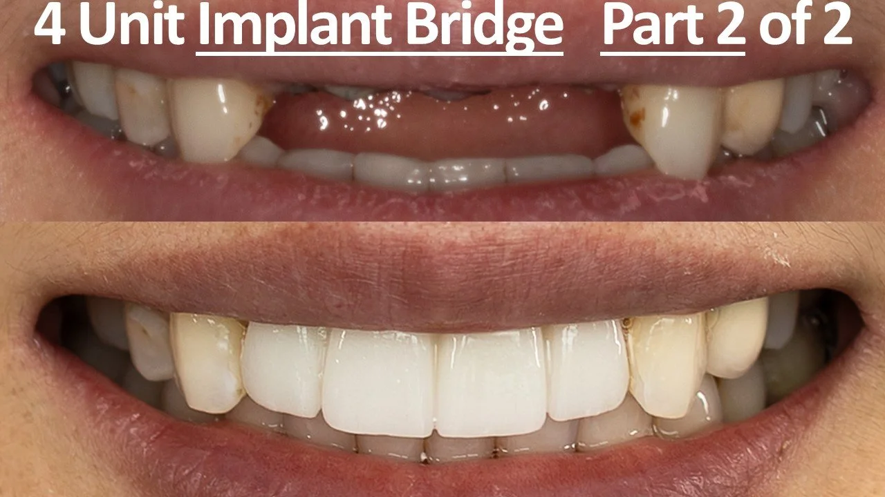Four Unit Implant Bridge, Front Teeth