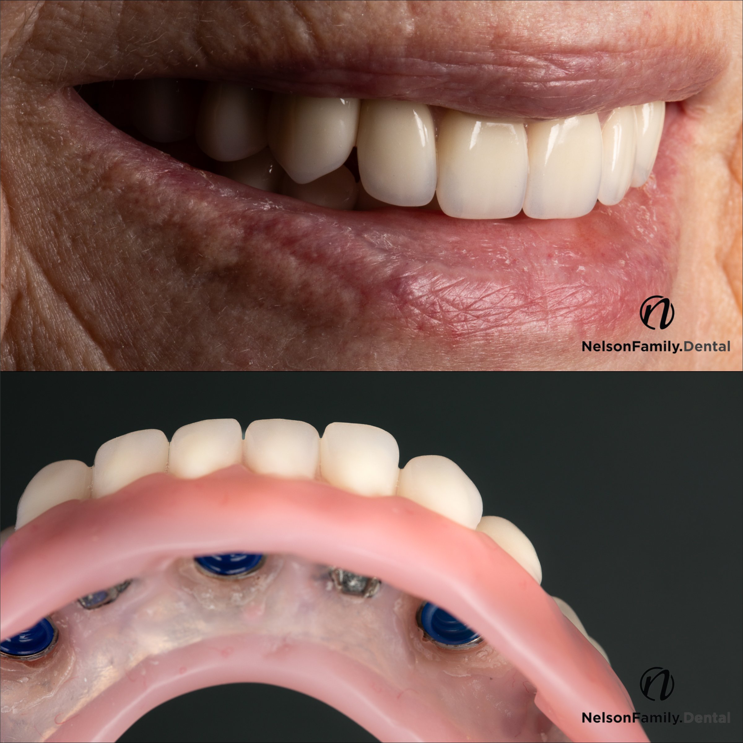 denture white before and after contraster.jpg