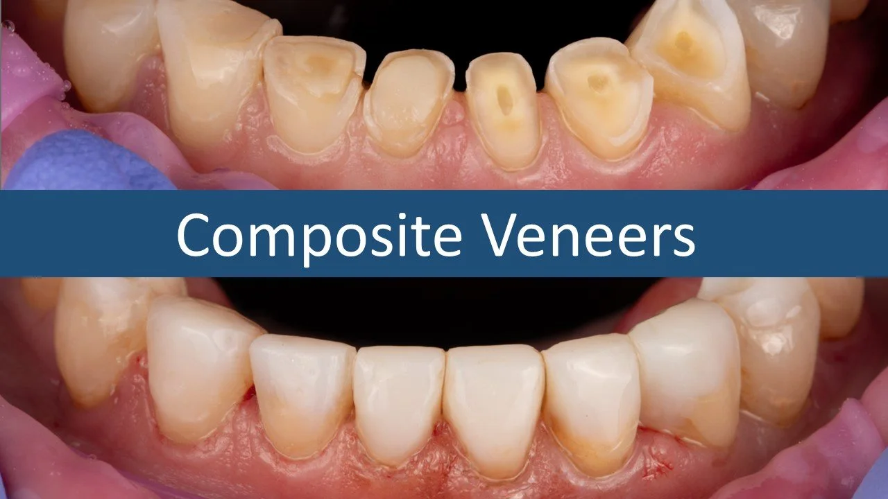 Composite Bonding and New Denture.jpg