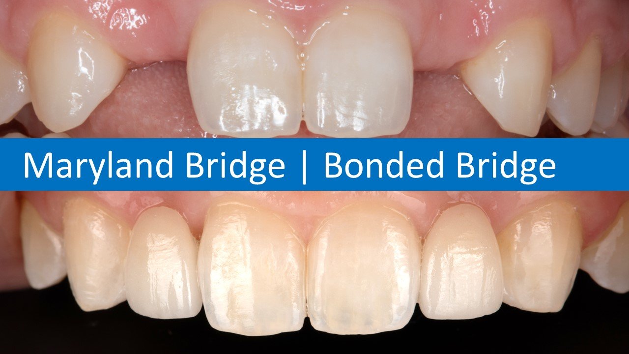 Maryland Bridge or Bonded Bridge.jpg
