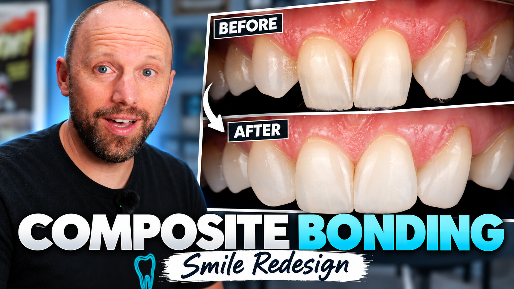 Composite Bonding Closing Gaps